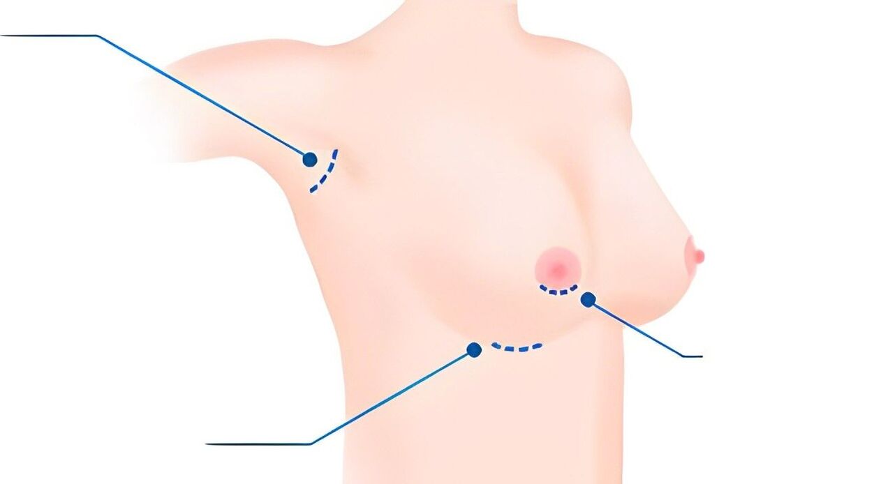 tipos de tallas para o aumento de mama